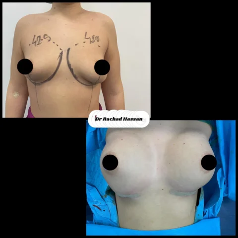 Caz implant mamar 087