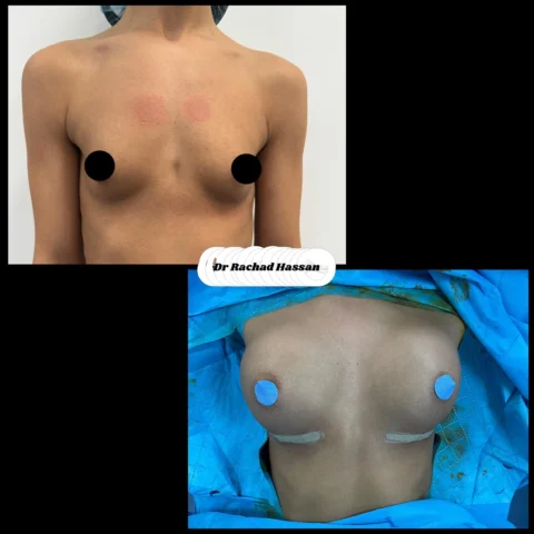 Caz implant mamar 089