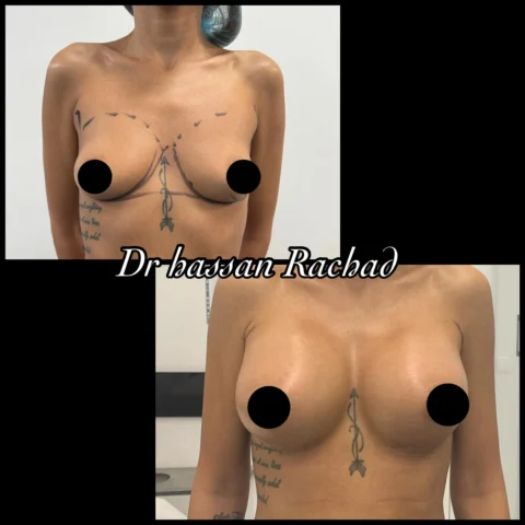 Caz implant mamar 097