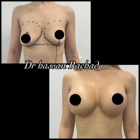 Caz implant mamar 099