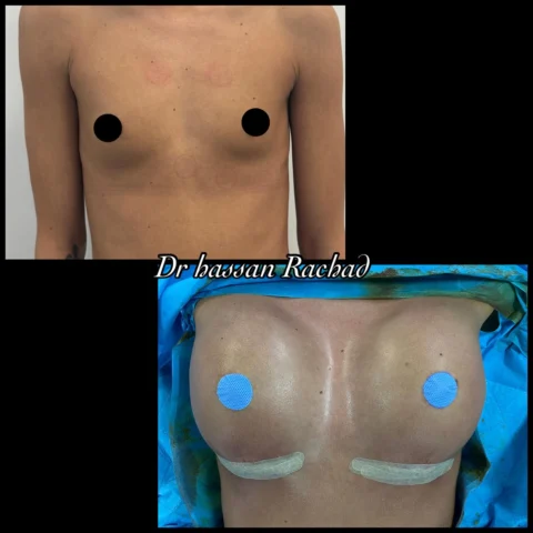 Caz implant mamar 103