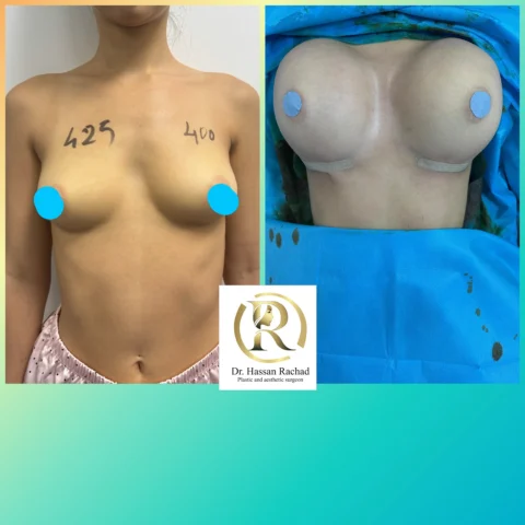 Caz implant mamar 107