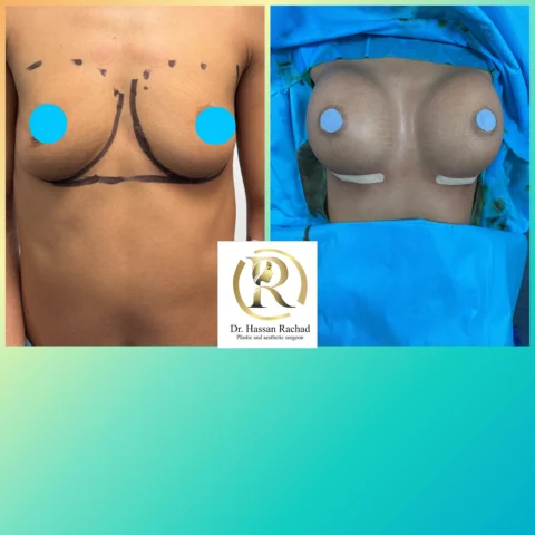 Caz implant mamar 124