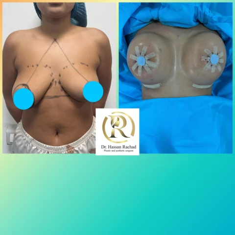 Caz implant mamar 128