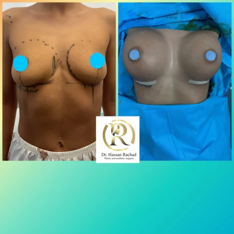 Caz implant mamar 134