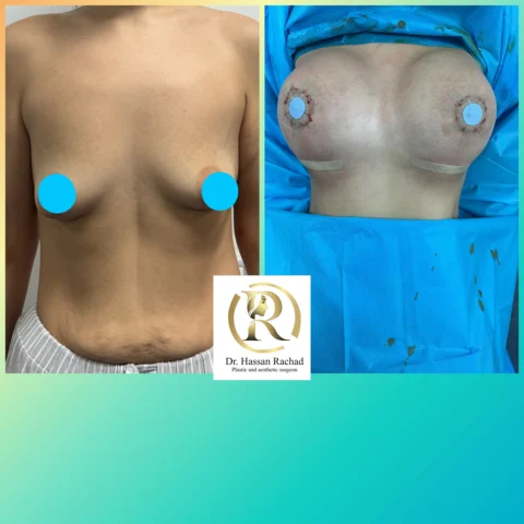 Caz implant mamar 138