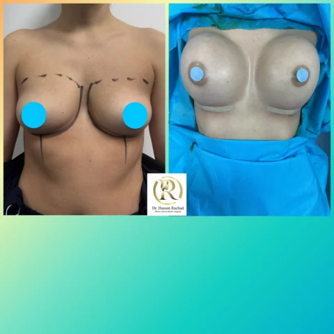 Caz implant mamar 142