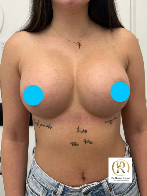 Caz implant mamar 145