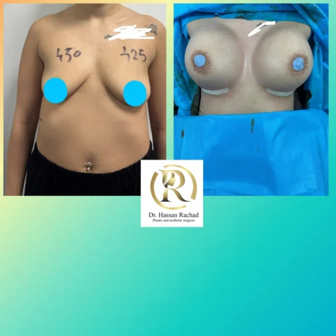 Caz implant mamar 147