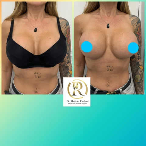 Caz implant mamar 149