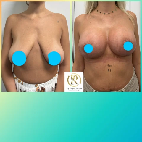 Caz implant mamar 156