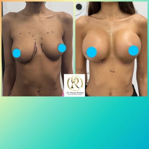 Caz implant mamar 157