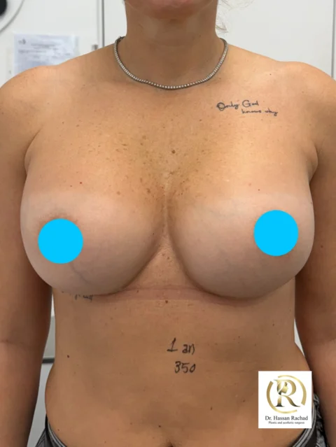 Caz implant mamar 160