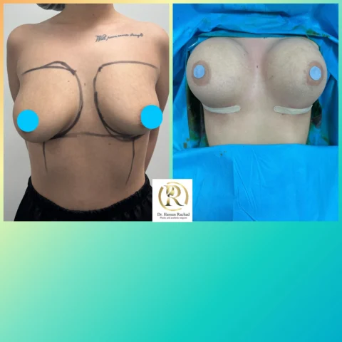 Caz implant mamar 161