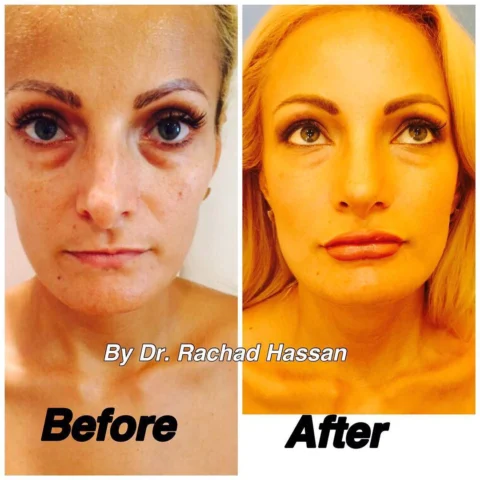 Caz blefaroplastie și rinoplastie 005