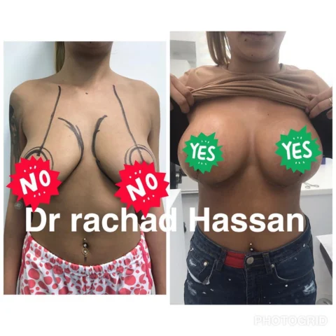 Caz implant mamar 006