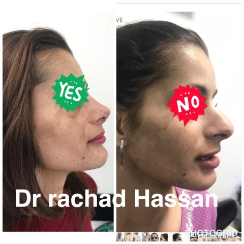 Caz rinoplastie 027