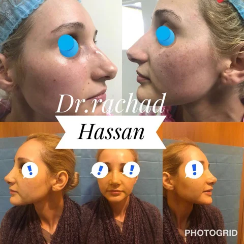 Caz rinoplastie 028