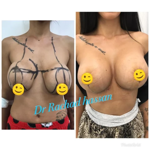 Caz lifting mamar și implant mamar 017