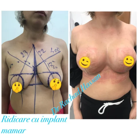 Caz lifting mamar și implant mamar 019