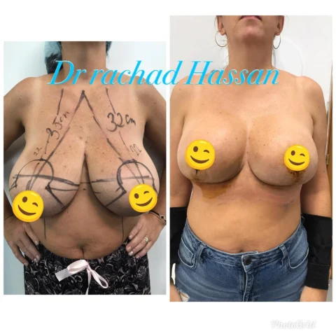 Caz reducție mamară și implant mamar 002