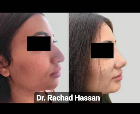 Caz rinoplastie 003