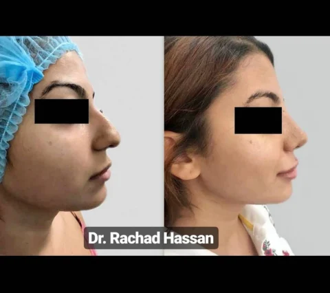 Caz rinoplastie 004