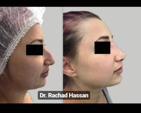 Caz rinoplastie 005