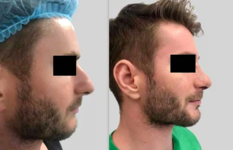 Caz rinoplastie 006