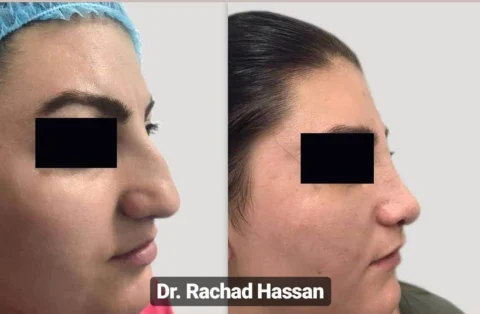 Caz rinoplastie 007
