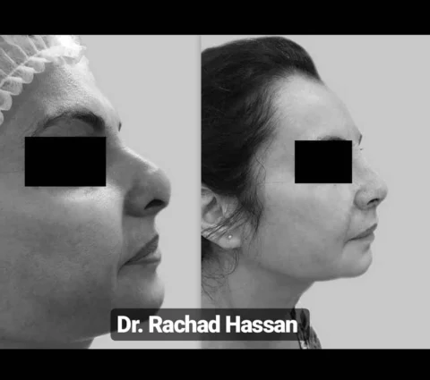 Caz rinoplastie 009