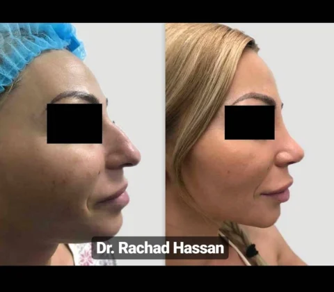 Caz rinoplastie 010