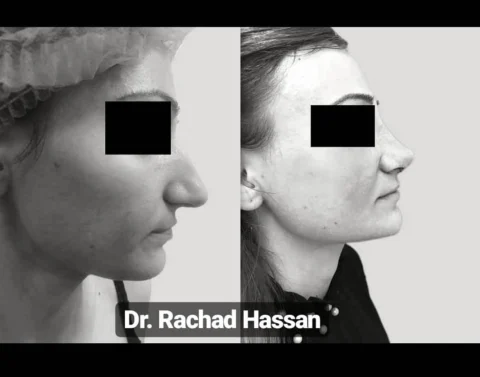 Caz rinoplastie 011