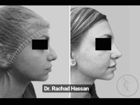 Caz rinoplastie 013