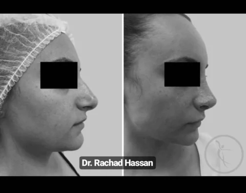 Caz rinoplastie 014