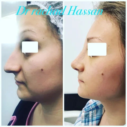 Caz rinoplastie 016