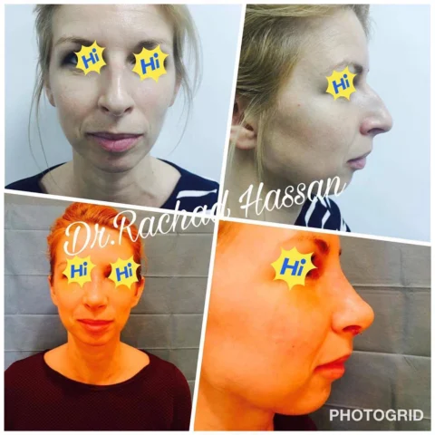Caz rinoplastie 030