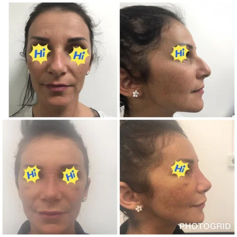Caz rinoplastie 031