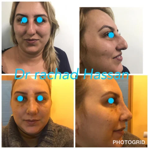 Caz rinoplastie 032