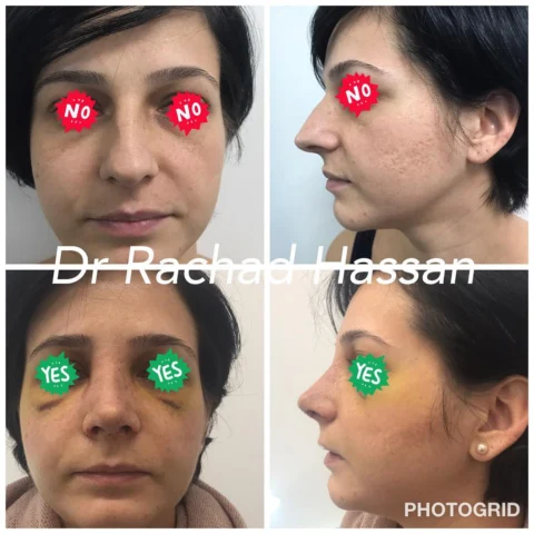 Caz rinoplastie 033