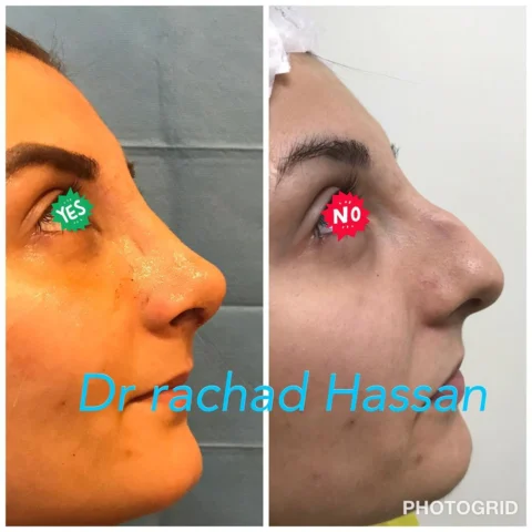Caz rinoplastie 034