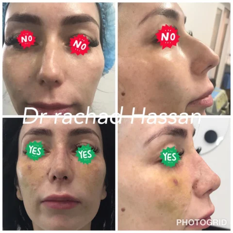Caz rinoplastie 035