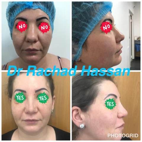 Caz rinoplastie 036