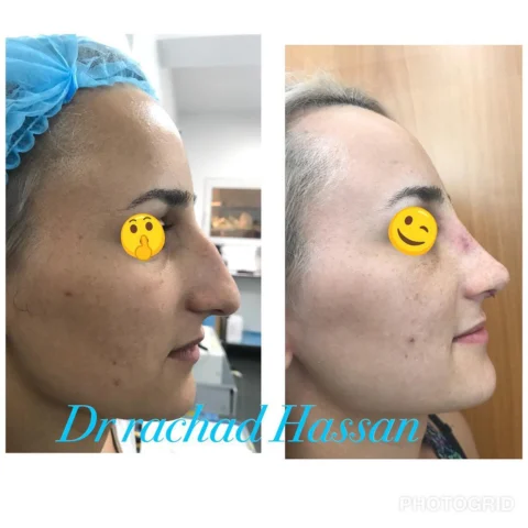 Caz rinoplastie 041