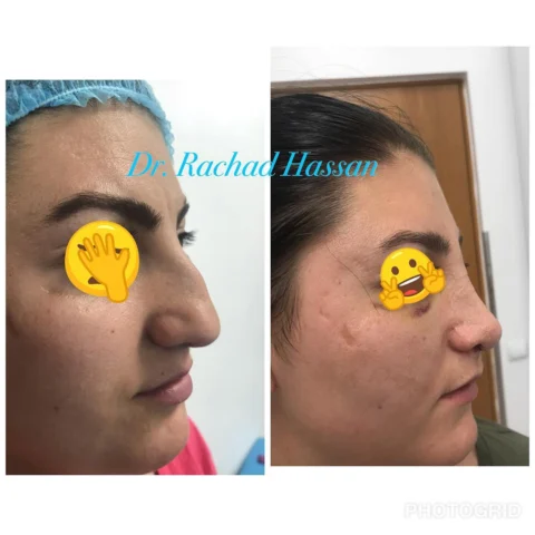 Caz rinoplastie 042