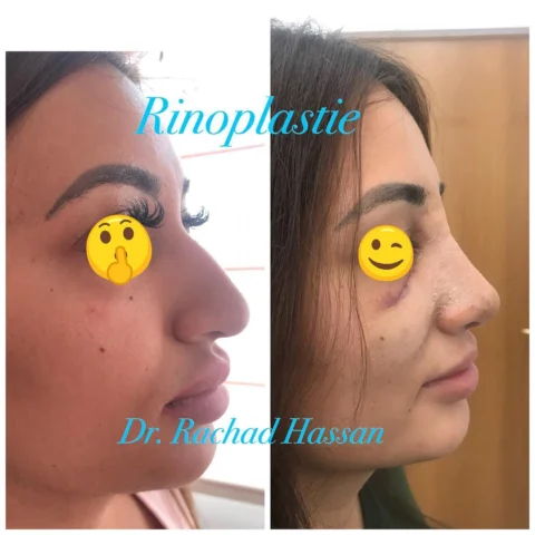 Caz rinoplastie 043