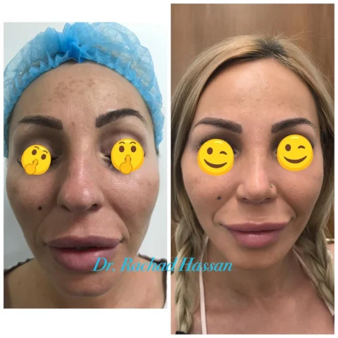 Caz rinoplastie 044