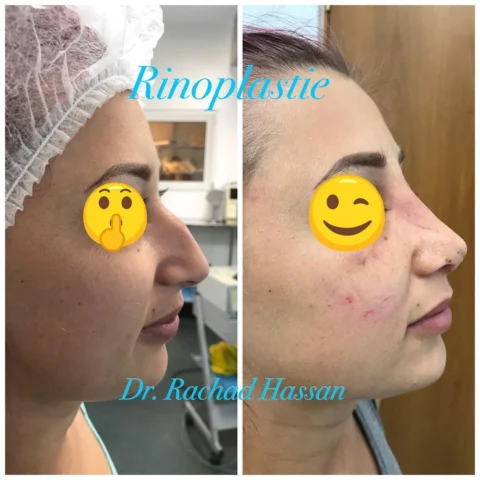Caz rinoplastie 045