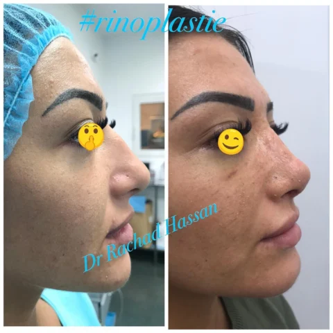Caz rinoplastie 046