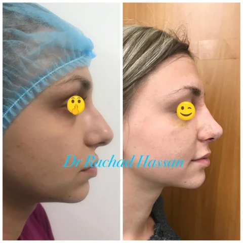 Caz rinoplastie 047